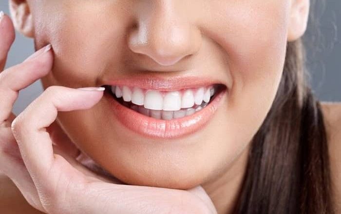 لومینیرز سرامیکی